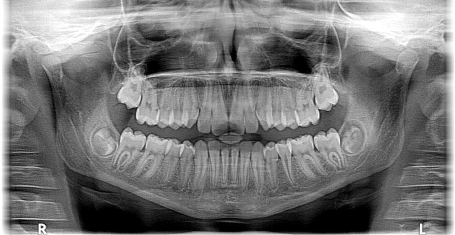 informe forense de médico con radiografía maxilofacial hecha por odontólogo